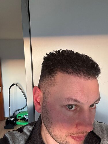 Ozlem Bicer MD-Hair Transplant-2910 Grafts FUE by micro-motor, 7. months result photo