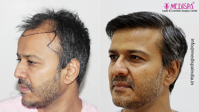 Dr. Suneet Soni - 4889 Grafts | 2.5 Years Result | Combination FUT + FUE + Beard photo