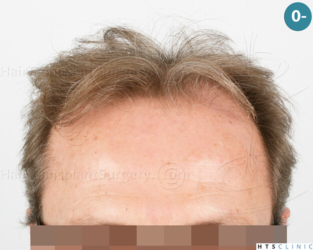 Dr Devroye + Dr Montesanti + Dr Jenard / 7015 grafts (4512 FUT + 2503 FUE) / 2 sessions photo