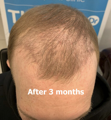 Lee's hair restoration journey - very fine/light hair - Dr Arshad (The Hair Dr Clinic, Leeds, UK) photo