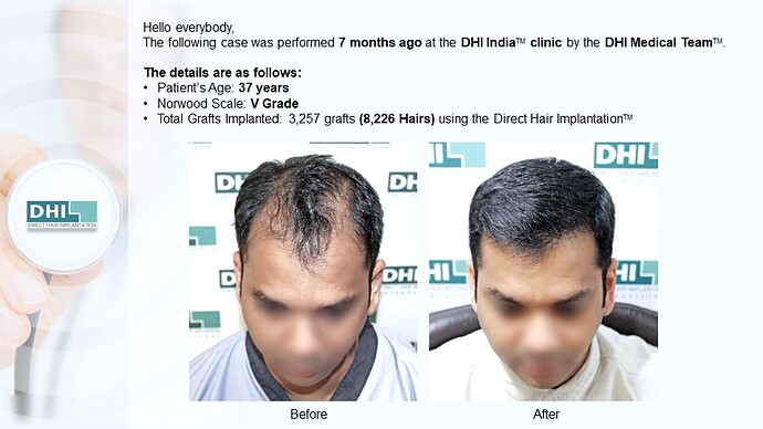 DHI India™ | NW 5 | 3,257 Grafts | 7 Months Hair Transplant Result photo