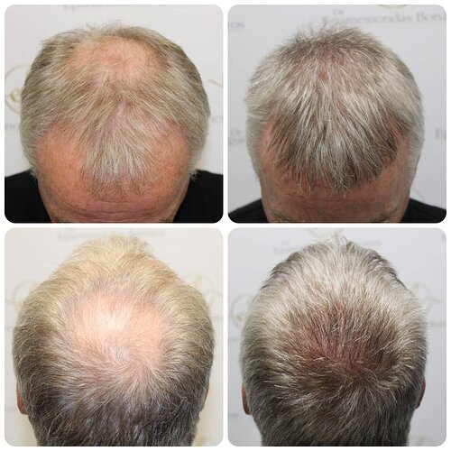 Dr Bonaros, Glasgow, UK / 3413 FUE grafts / 0-12 Months photo