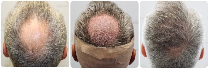 Dr Bonaros, Glasgow, UK / 1858 FUE grafts / 0-12 Months photo