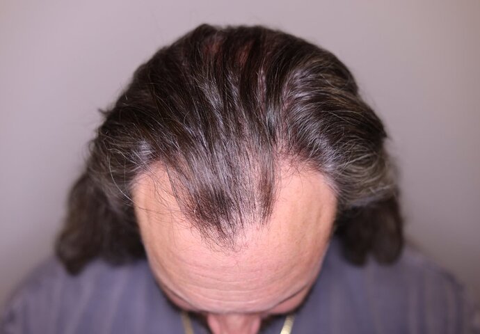 Utah Hair Restoration - Dr. Barton alviarmani photo