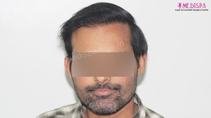 Revision Hair Transplant - 5111 Grafts / 5 Years Result - Dr. Suneet Soni, Medispa India photo