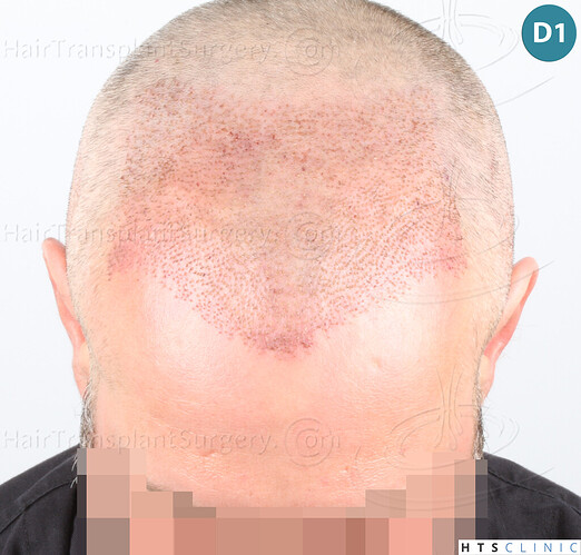 Dr Devroye + Dr Montesanti + Dr Jenard, HTS Clinic / 2932 FUE / Hairline & frontal area photo