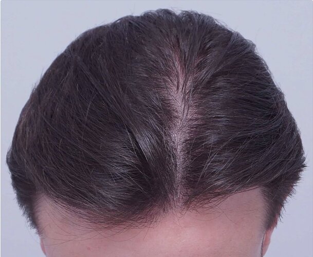 Dr Bessam Farjo FUE 1720 grafts to frontal recessions photo