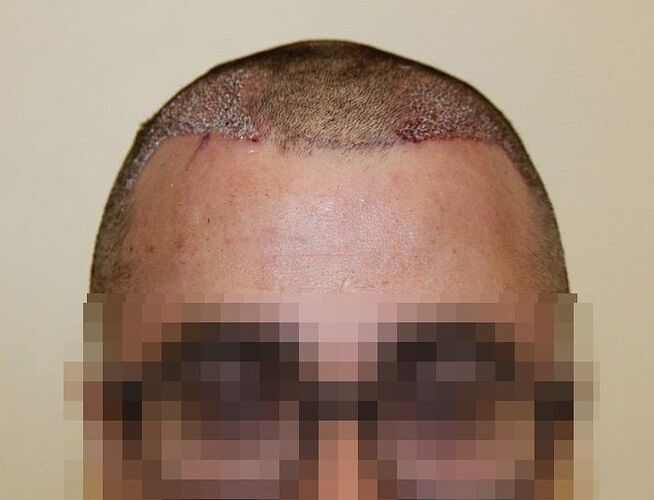Dr. Bisanga, BHR Clinic, 1660 FUE / 0-7,5 Months photo