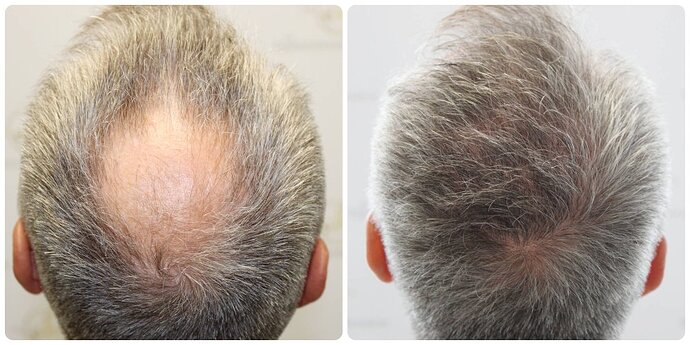 Dr Bonaros, Glasgow, UK / 1858 FUE grafts / 0-12 Months photo