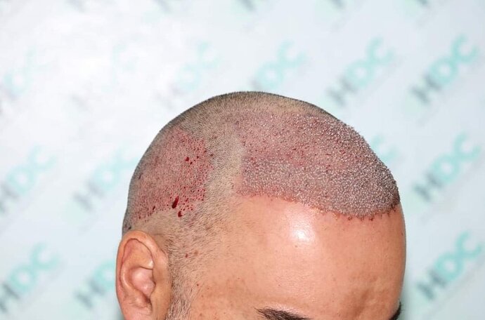 3567 FUE grafts for NW4 paitent by Dr. Maras at HDC clinic photo
