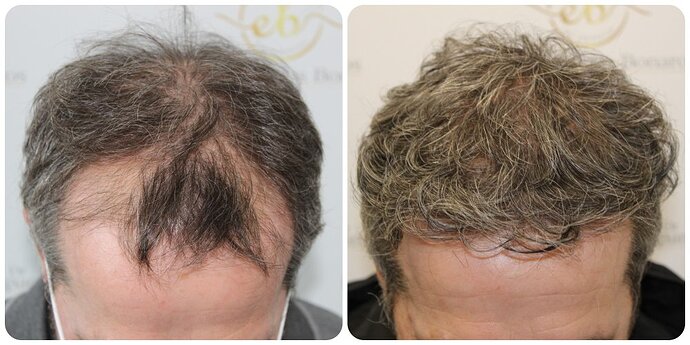 Dr Bonaros, Glasgow, UK / 3595 FUE grafts / 0-12 Months photo