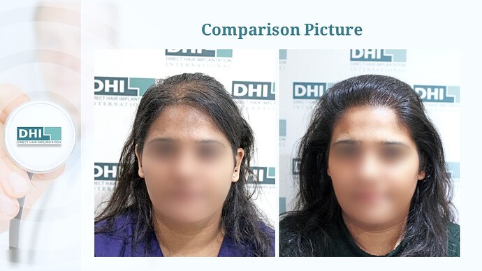 Female Hair Transplant | 1,359 Grafts | 6-Months Result | DHI India™ photo