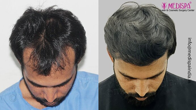 Dr. Suneet Soni - 3029 FUE Grafts, FUE Method (Trivellini System), NW - III photo