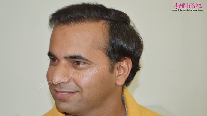 11600 Grafts in 3 FUT Sittings by Dr Suneet Soni photo