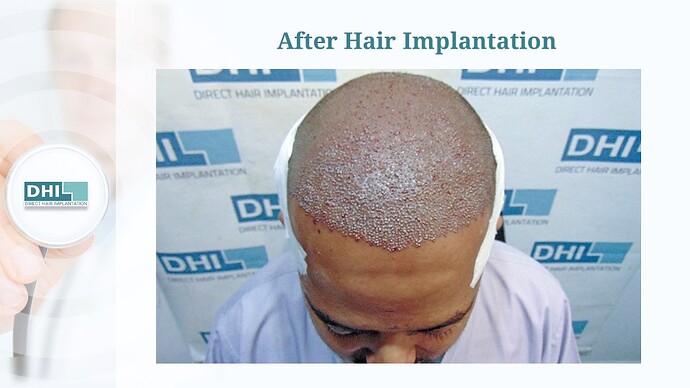 DHI India™ | NW 3 | 3,506 Grafts | 7 Months Hair Transplant photo