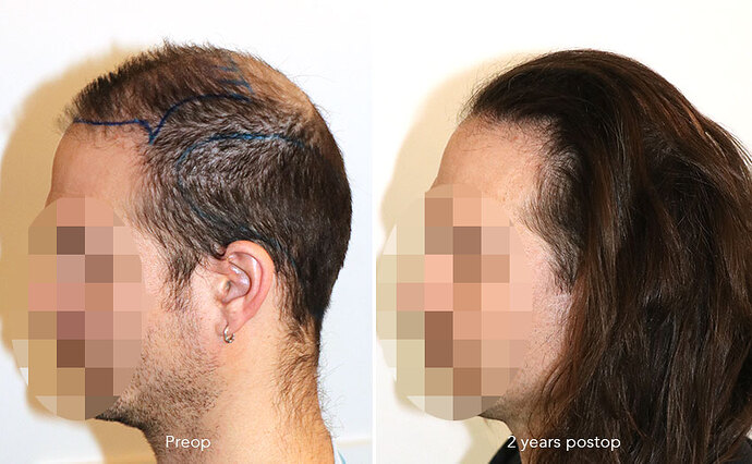 Case performed by Dr. Feriduni – 3346 FU in 1 procedure photo