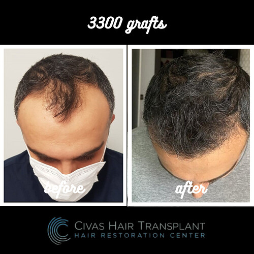 Civas Hair Transplant (Dr Ekrem Civas) -- 3300 grafts fue -- after 1 year photo