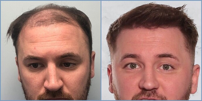 Dr. Nikos hair transplant result, grown out - hairline back over the mid-scalp 2850 grafts photo