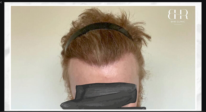 Dr.Bisanga, BHR Clinic, 3500 FUE Hairline and Crown Reconstruction photo
