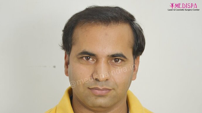 11600 Grafts in 3 FUT Sittings by Dr Suneet Soni photo