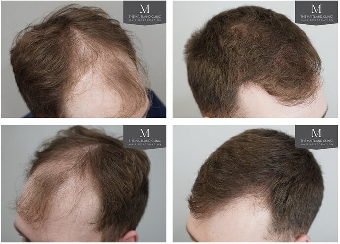 The Maitland Clinic - 2027 grafts by FUE photo