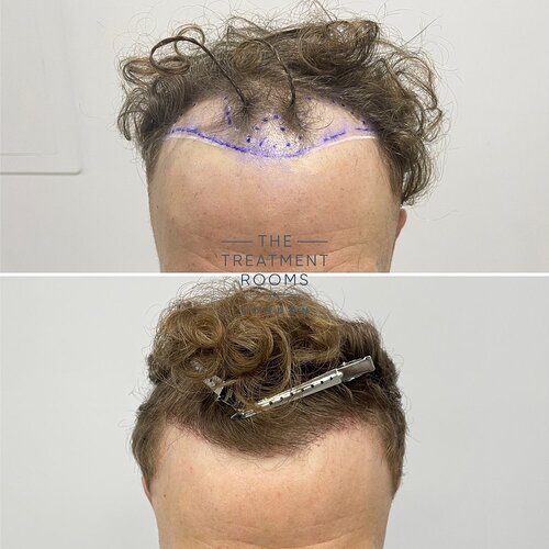 1514 Grafts Hairline Hair Transplant- The Treatment Rooms London photo