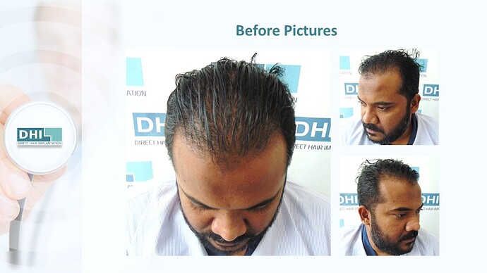 DHI India™ | NW 3 | 4,821 Grafts | 1 year DHI Hair Transplant Results photo