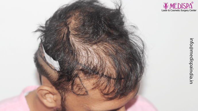 Dr. Suneet Soni - 4665 Grafts, Combine FUT + FUE + BHT (Beard) Technique photo