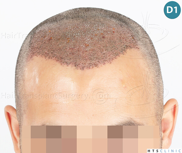 Dr Devroye + Dr Montesanti + Dr Jenard, HTS Clinic / 2018 FUE / Hairline & frontal area photo