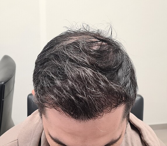 FUE Result for 4400 Grafts – 6 Months after – HDC Hair Clinic photo
