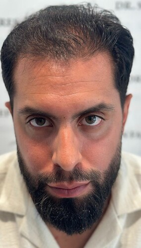 Dr Fares Seffen (Tunis, Tunisia) 3760 FUE results (Diffuse NW 4) Day 0 --> 10 Months after photo