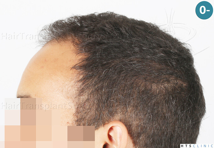 Dr Devroye + Dr Montesanti + Dr Jenard, HTS Clinic / 2018 FUE / Hairline & frontal area photo