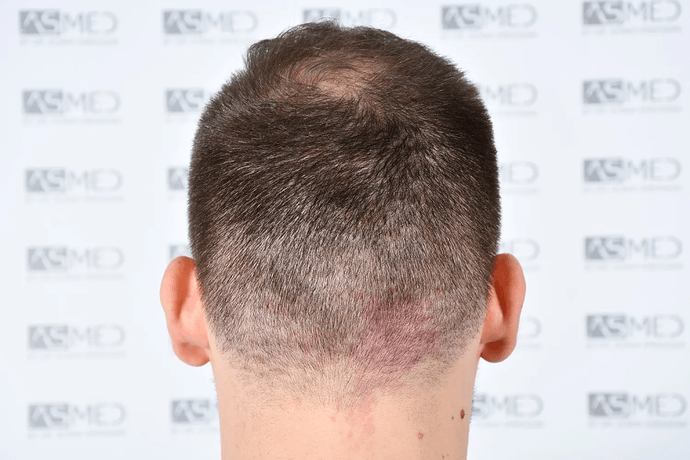 ASMED, Istanbul: 5,071 Manual FUE Grafts 0/12 Months photo