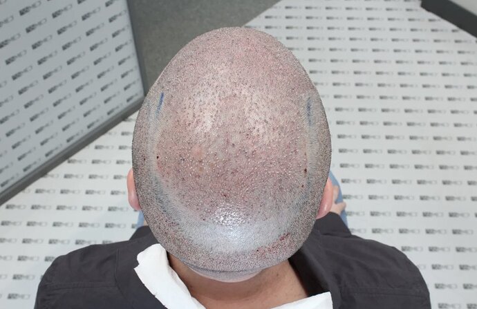 ASMED CLINIC CASE - DR.KORAY 5000 GRAFTS FUE photo