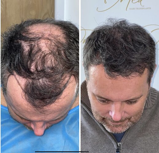 Dr Ted Miln (UK) | 6,120 grafts | FUT+FUE combo | Hairline, midscalp & crown restoration | 8.5 months post-op photo