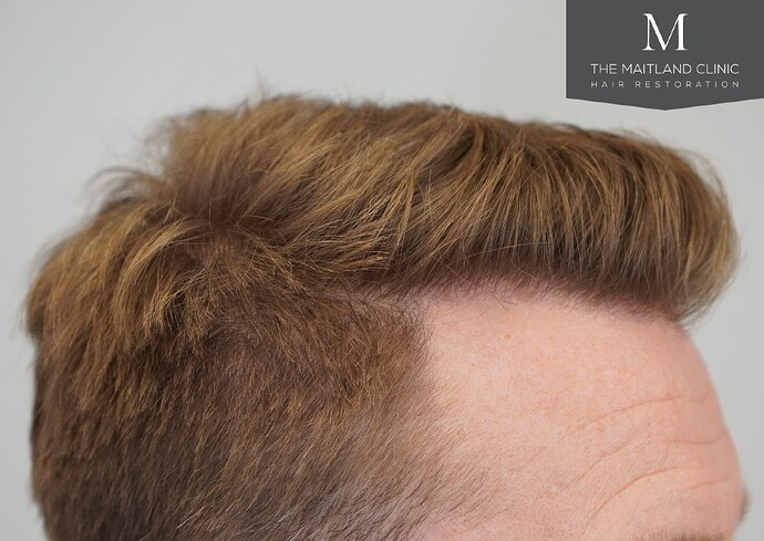 Dr Ball - The Maitland Clinic 1204 Grafts By FUE photo