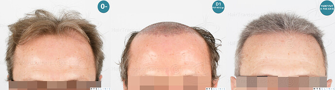 Dr Devroye + Dr Montesanti + Dr Jenard / 7015 grafts (4512 FUT + 2503 FUE) / 2 sessions photo