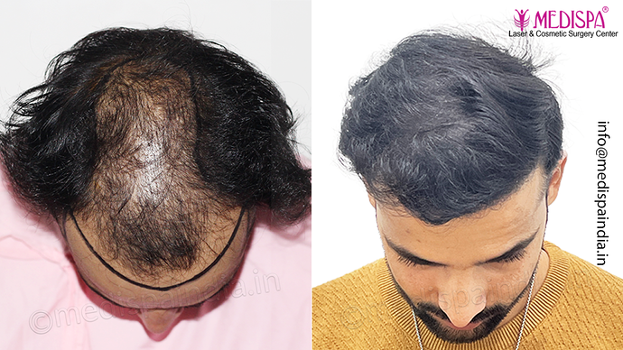 Dr. Suneet Soni - 4046 Grafts | 12-Month Result | Combination FUT + FUE + Beard photo