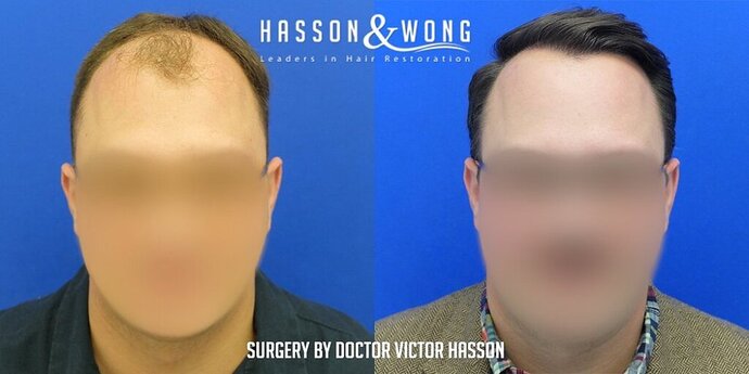 Dr. Hasson / 4,511 grafts / FUE / Frontal zone /mid / 3 years post-op photo