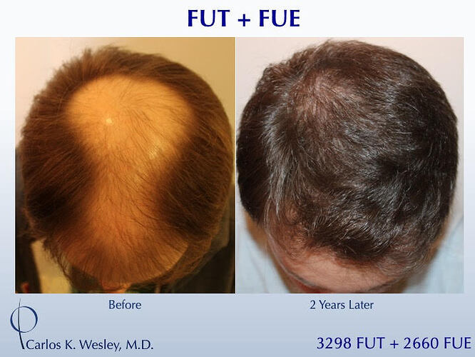 (Combined FUT 3298 & FUE 2660 grafts): Carlos K. Wesley, M.D. (NYC & LA) photo