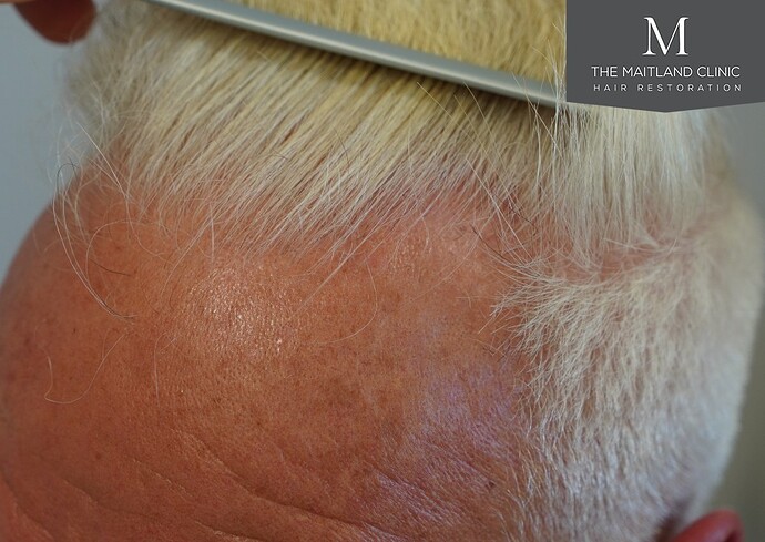 Dr Ball - The Maitland Clinic 2280 Grafts by FUE photo