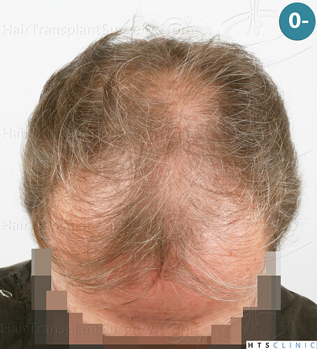 Dr Devroye + Dr Montesanti + Dr Jenard / 7015 grafts (4512 FUT + 2503 FUE) / 2 sessions photo