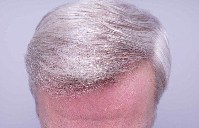 Dr B Farjo 1750g FUE to frontal recessions. photo