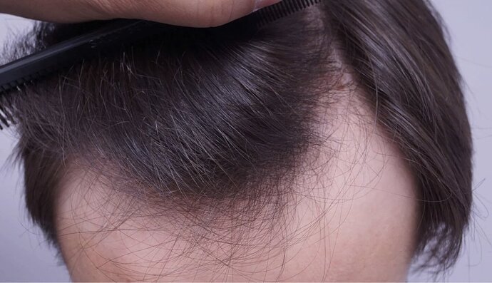 Dr Bessam Farjo FUE 1720 grafts to frontal recessions photo