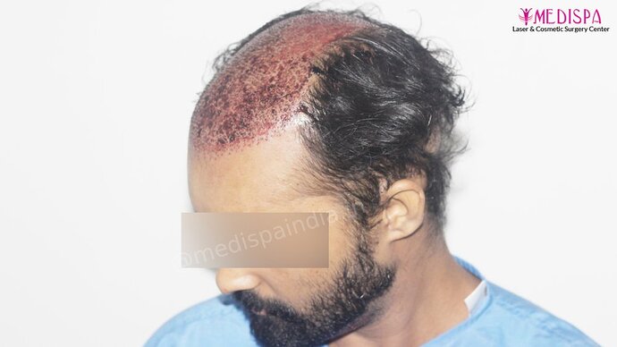 Revision Hair Transplant - 5111 Grafts / 5 Years Result - Dr. Suneet Soni, Medispa India photo