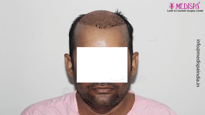 Dr. Suneet Soni - 4992 Grafts | 12-Month Result | Combination FUT + FUE + Beard photo