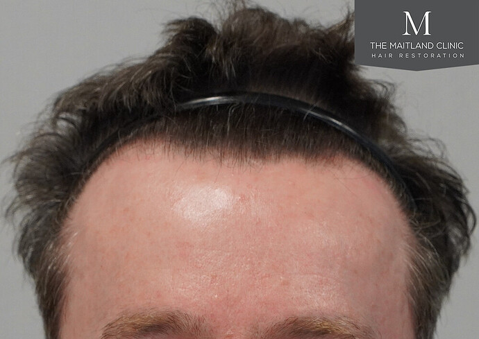 Before and after results: 1694 grafts by FUE at The Maitland Clinic (Dr Edward Maitland Ball) photo