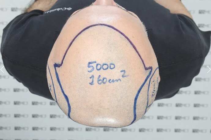 Asmed Clinic - FUE Hair Transplant - 5041 Grafts photo
