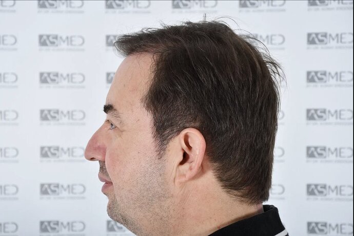 ASMED CLINIC - DR.KORAY - 5060 GRAFTS FUE photo