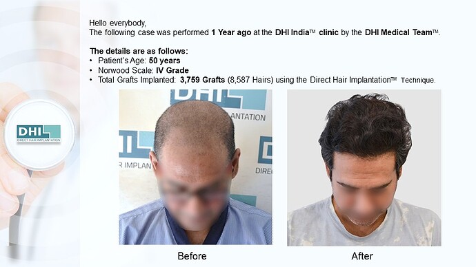 DHI India™ | NW 4 | 3,759 Grafts | 1 year DHI Hair Transplant Results photo